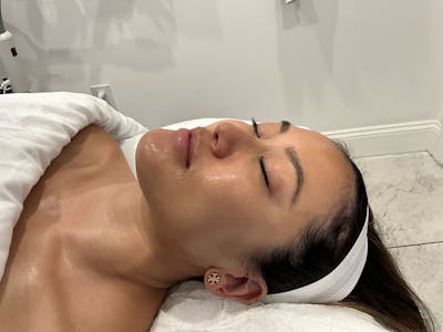 Hydrafacial Before & After Gallery - Patient 415160 - Image 2