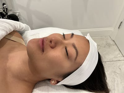 Hydrafacial Before & After Gallery - Patient 415160 - Image 1