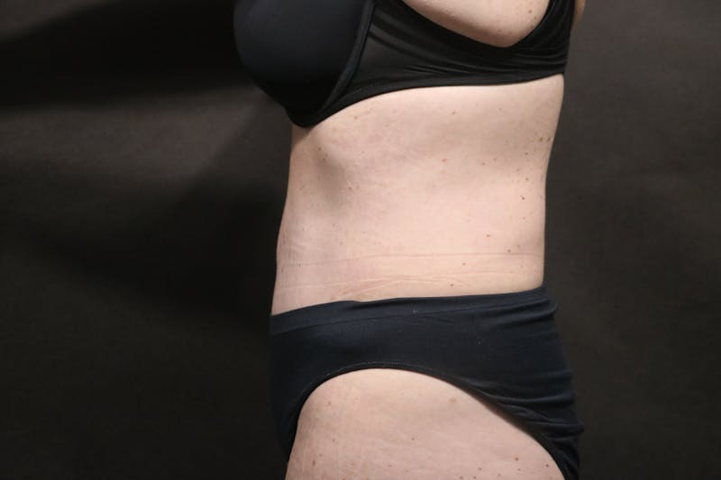 Tummy Tuck Before & After Gallery - Patient 325822 - Image 2