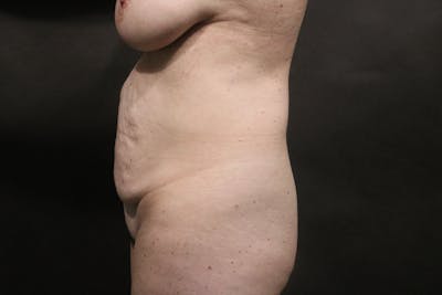 Tummy Tuck Before & After Gallery - Patient 325822 - Image 1