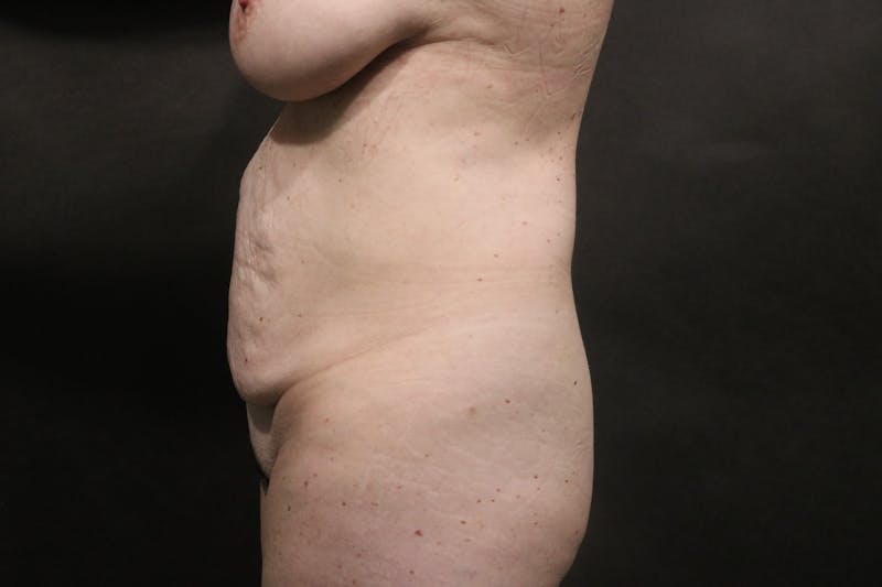 Tummy Tuck Before & After Gallery - Patient 325822 - Image 1