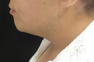Ultherapy Before & After Gallery - Patient 365192 - Image 1