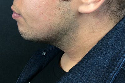 Ultherapy Before & After Gallery - Patient 365192 - Image 2