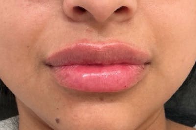 Juvederm / Voluma / Volbella / Kybella Before & After Gallery - Patient 124900 - Image 2