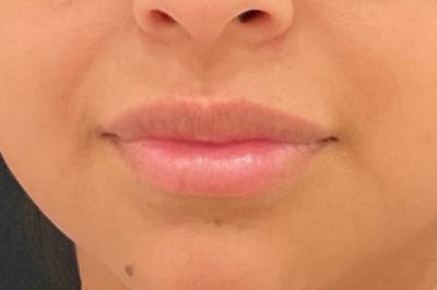 Juvederm / Voluma / Volbella / Kybella Before & After Gallery - Patient 124900 - Image 1