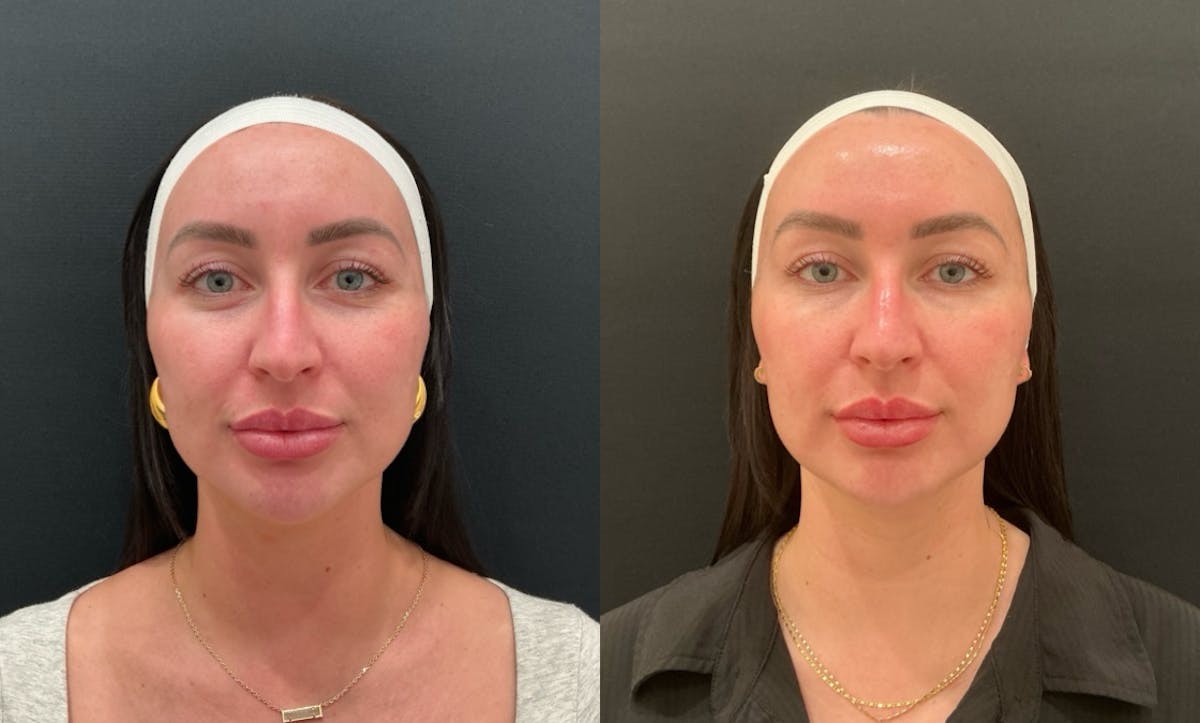 VI Peel Before & After Gallery - Patient 189084 - Image 1