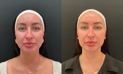 VI Peel Before & After Gallery - Patient 189084 - Image 1