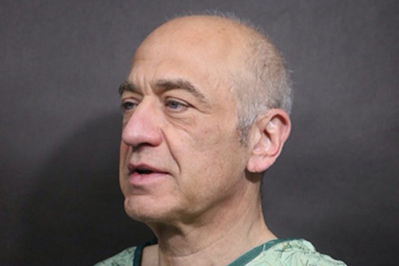 Facelift Before & After Gallery - Patient 427338 - Image 1
