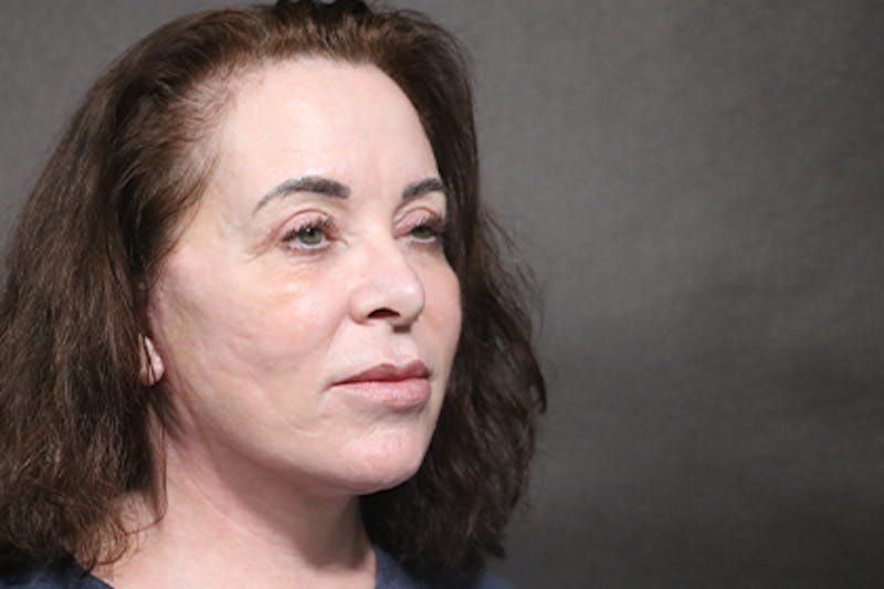 Facelift Before & After Gallery - Patient 163254 - Image 2