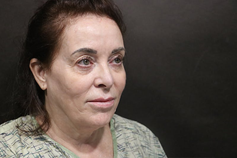 Facelift Before & After Gallery - Patient 163254 - Image 1