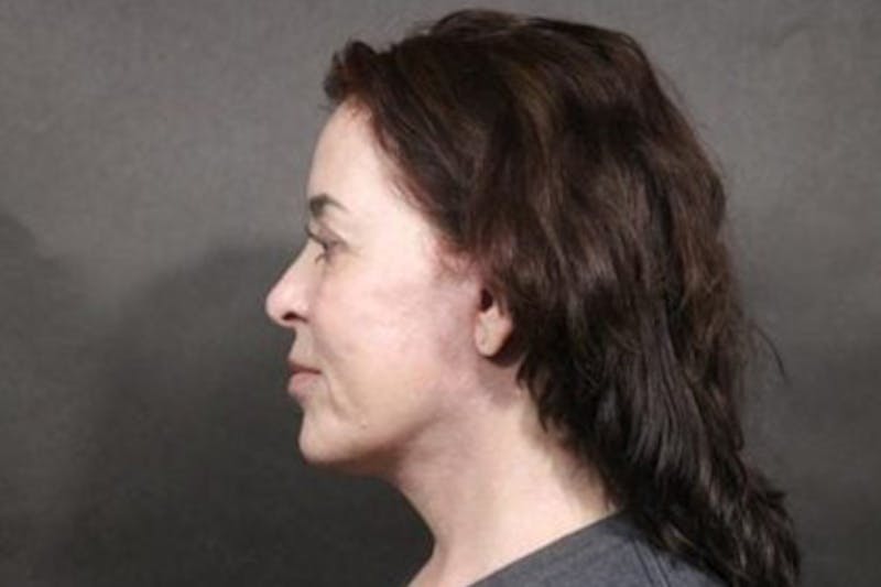 Facelift Before & After Gallery - Patient 406555 - Image 2