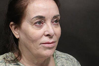 Facelift Before & After Gallery - Patient 163254 - Image 1