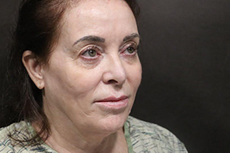 Facelift Before & After Gallery - Patient 163254 - Image 1