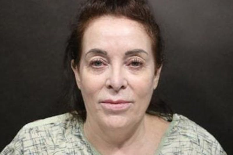 Facelift Before & After Gallery - Patient 163254 - Image 3