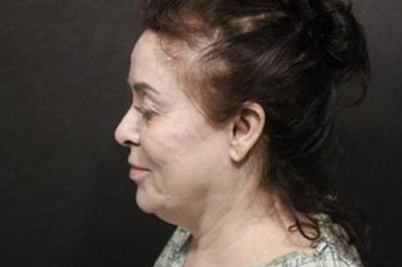 Facelift Before & After Gallery - Patient 406555 - Image 1