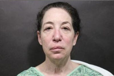 Facelift Before & After Gallery - Patient 233130 - Image 1
