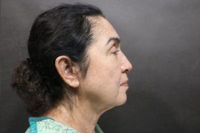 Facelift Before & After Gallery - Patient 215297 - Image 1