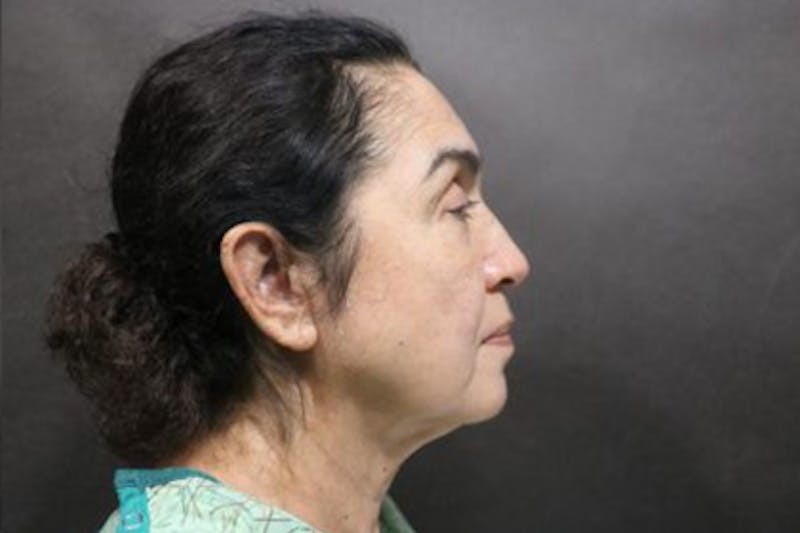 Facelift Before & After Gallery - Patient 215297 - Image 1