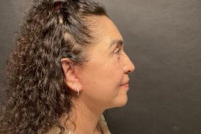 Facelift Before & After Gallery - Patient 215297 - Image 2