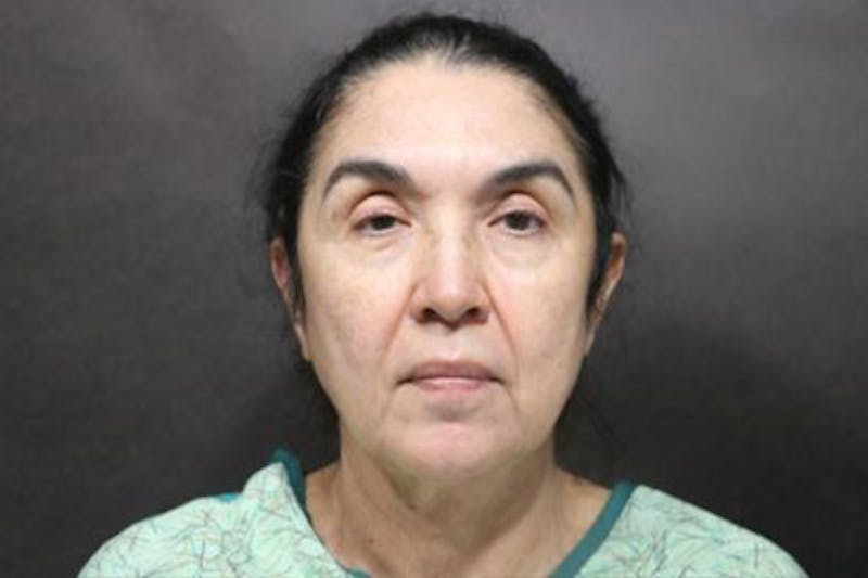 Facelift Before & After Gallery - Patient 121210 - Image 1