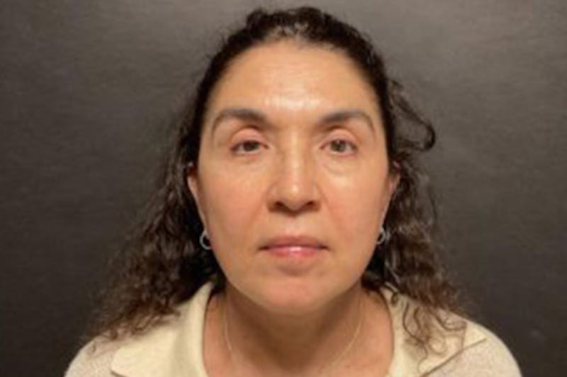 Facelift Before & After Gallery - Patient 121210 - Image 2