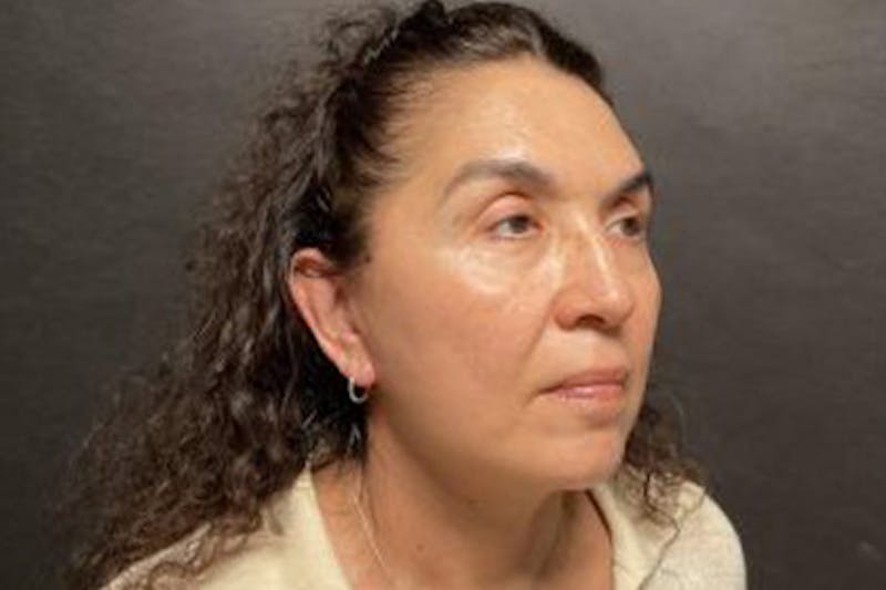 Facelift Before & After Gallery - Patient 215297 - Image 4