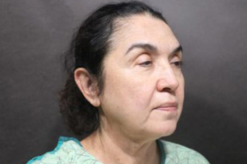 Facelift Before & After Gallery - Patient 215297 - Image 3