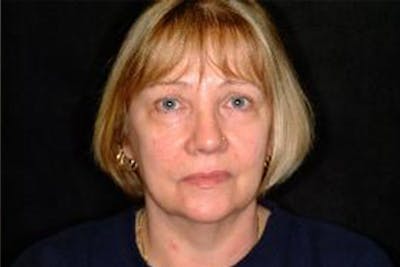 Facelift Before & After Gallery - Patient 276114 - Image 1