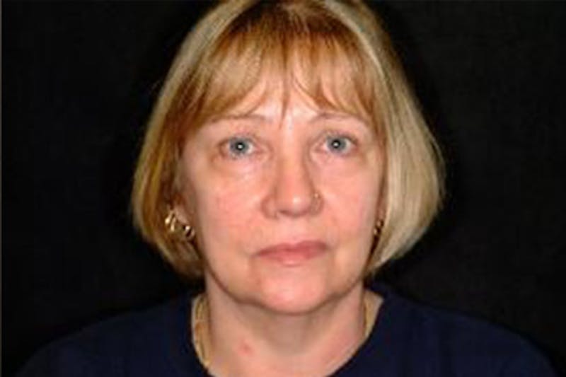 Facelift Before & After Gallery - Patient 276114 - Image 1