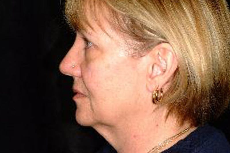 Facelift Before & After Gallery - Patient 276114 - Image 3