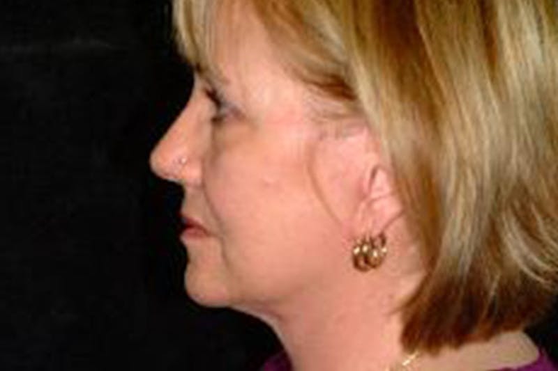Facelift Before & After Gallery - Patient 276114 - Image 4