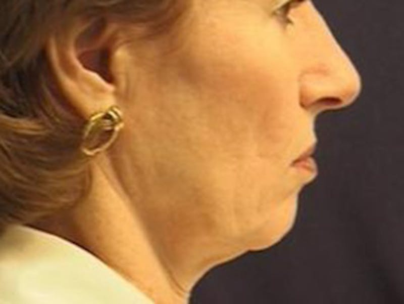 Facelift Before & After Gallery - Patient 326003 - Image 3