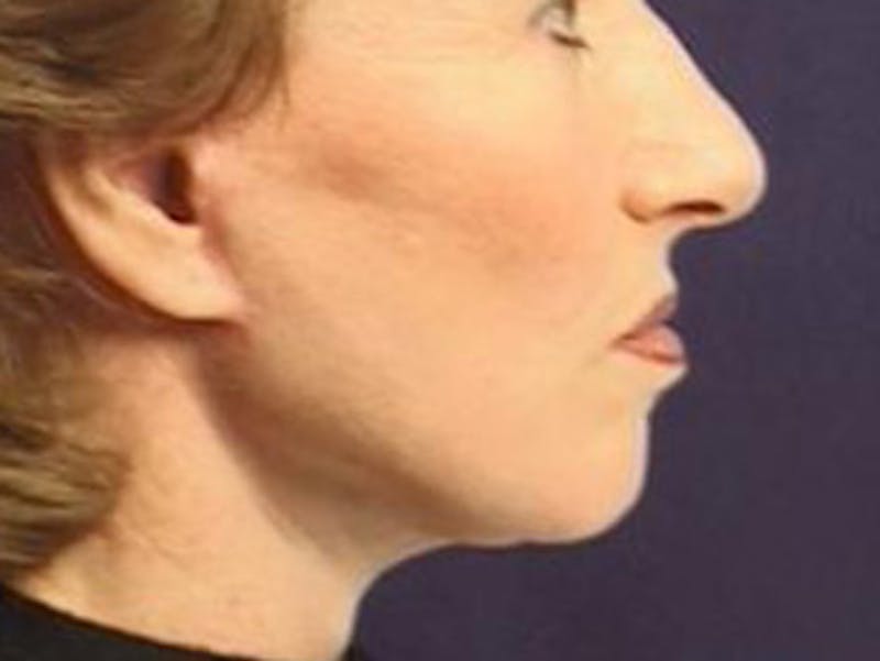 Facelift Before & After Gallery - Patient 326003 - Image 4