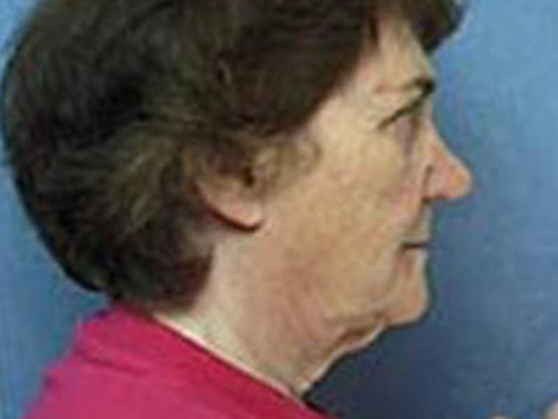Facelift Before & After Gallery - Patient 912701 - Image 1