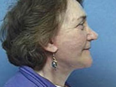 Facelift Before & After Gallery - Patient 912701 - Image 2