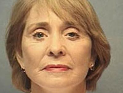 Facelift Before & After Gallery - Patient 152029 - Image 2