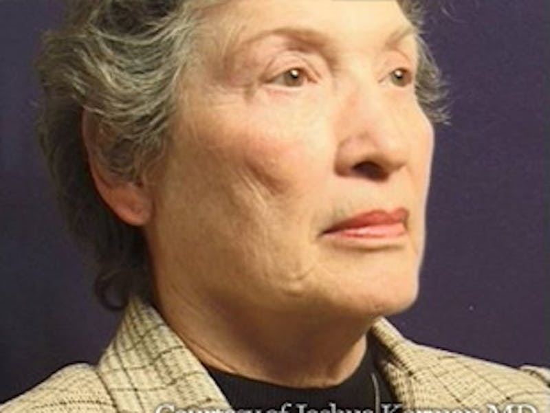 Facelift Before & After Gallery - Patient 357715 - Image 3