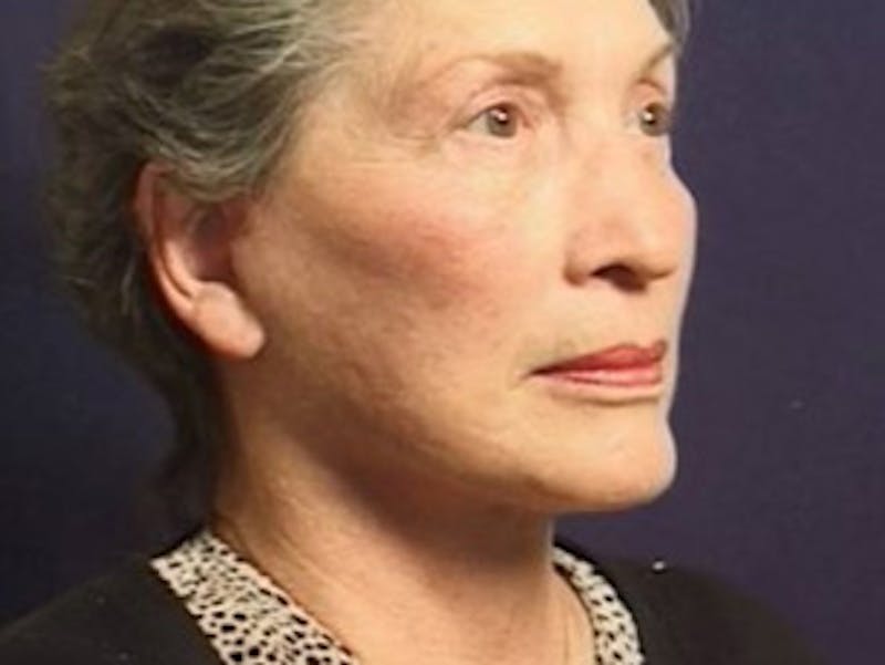 Facelift Before & After Gallery - Patient 357715 - Image 4