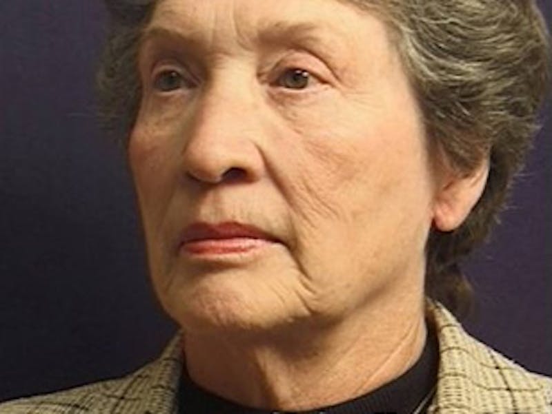 Facelift Before & After Gallery - Patient 357715 - Image 5
