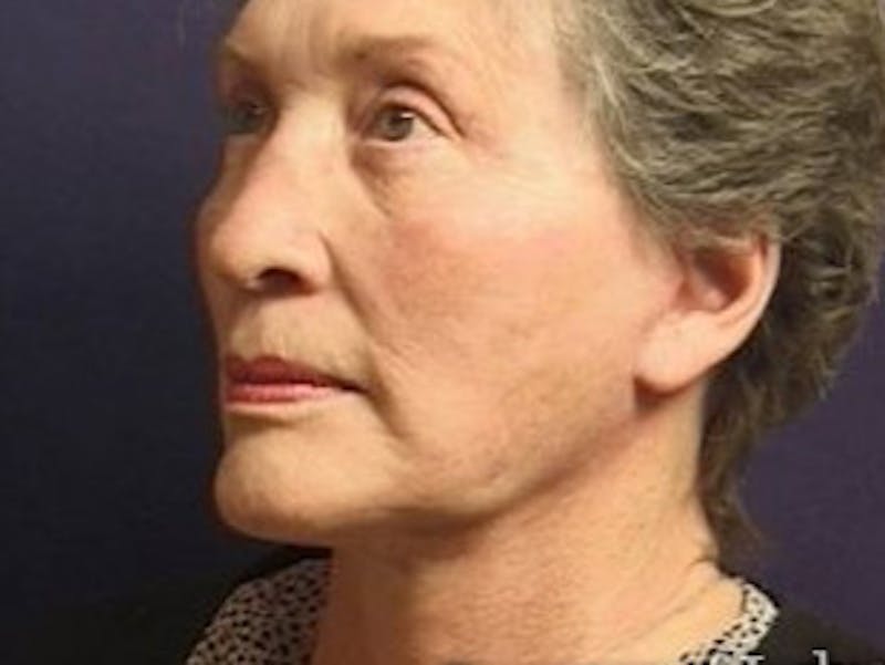 Facelift Before & After Gallery - Patient 357715 - Image 6