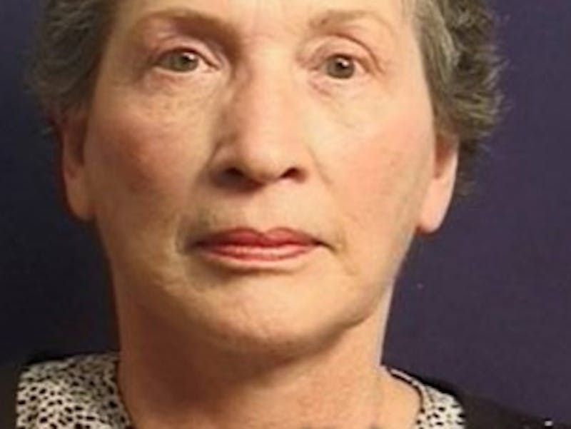 Facelift Before & After Gallery - Patient 357715 - Image 8