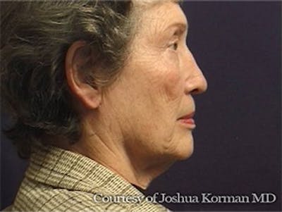 Facelift Before & After Gallery - Patient 357715 - Image 1