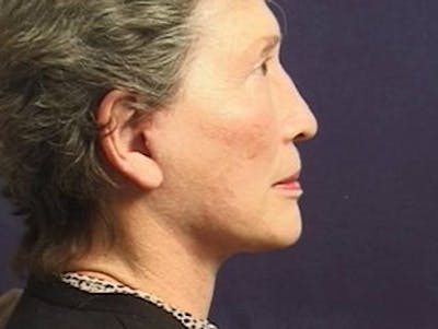 Facelift Before & After Gallery - Patient 357715 - Image 2