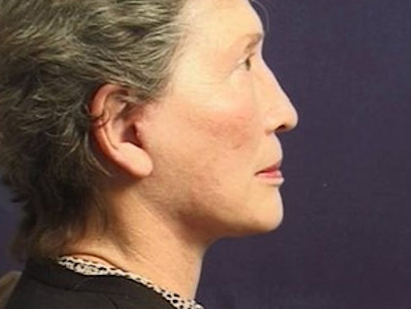 Facelift Before & After Gallery - Patient 357715 - Image 2