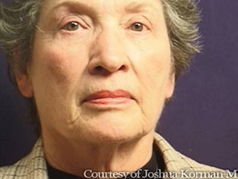 Facelift Before & After Gallery - Patient 357715 - Image 7