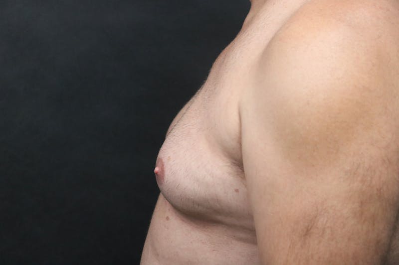 Male Breast Reduction (Gynecomastia) Before & After Gallery - Patient 300250 - Image 1