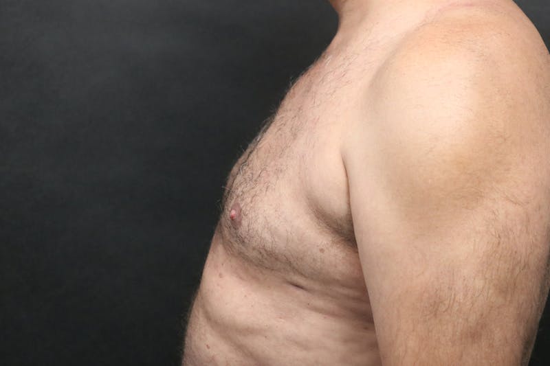 Male Breast Reduction (Gynecomastia) Before & After Gallery - Patient 300250 - Image 2