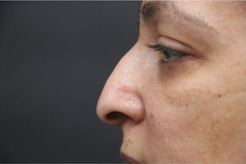 Rhinoplasty Before & After Gallery - Patient 360952 - Image 1