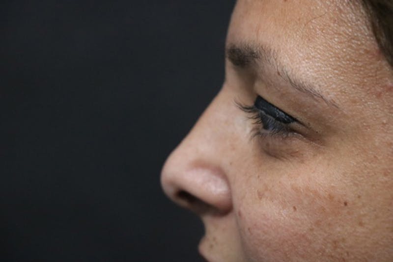 Rhinoplasty Before & After Gallery - Patient 360952 - Image 2
