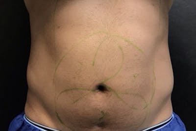 Ab Etching Before & After Gallery - Patient 280360 - Image 1